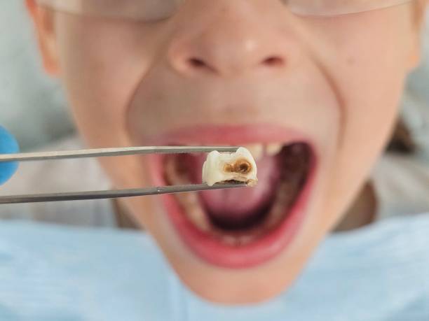 Best Emergency Treatment for Dental Infections or Abscesses in Coconut Creek, FL