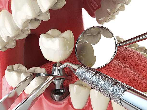 Best Emergency Dental Care for Broken or Chipped Teeth in Coconut Creek, FL